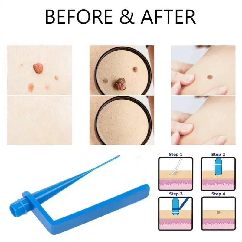 Boluoyin Skin Tag Remover Kit for Face Care and Mole