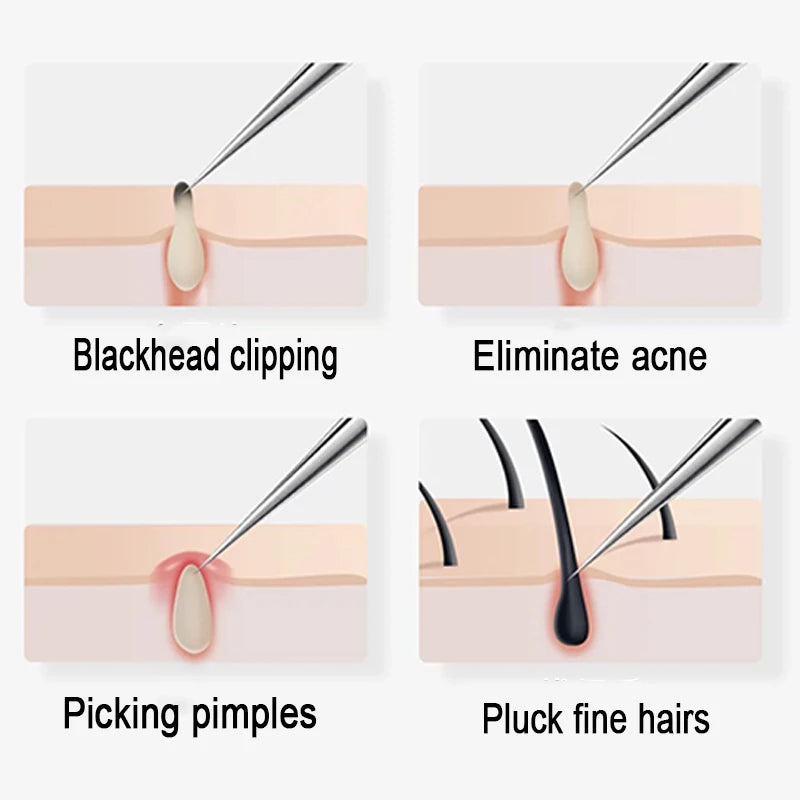 Hign Concerned Acne Needle Blackhead Removal Tweezers Tool