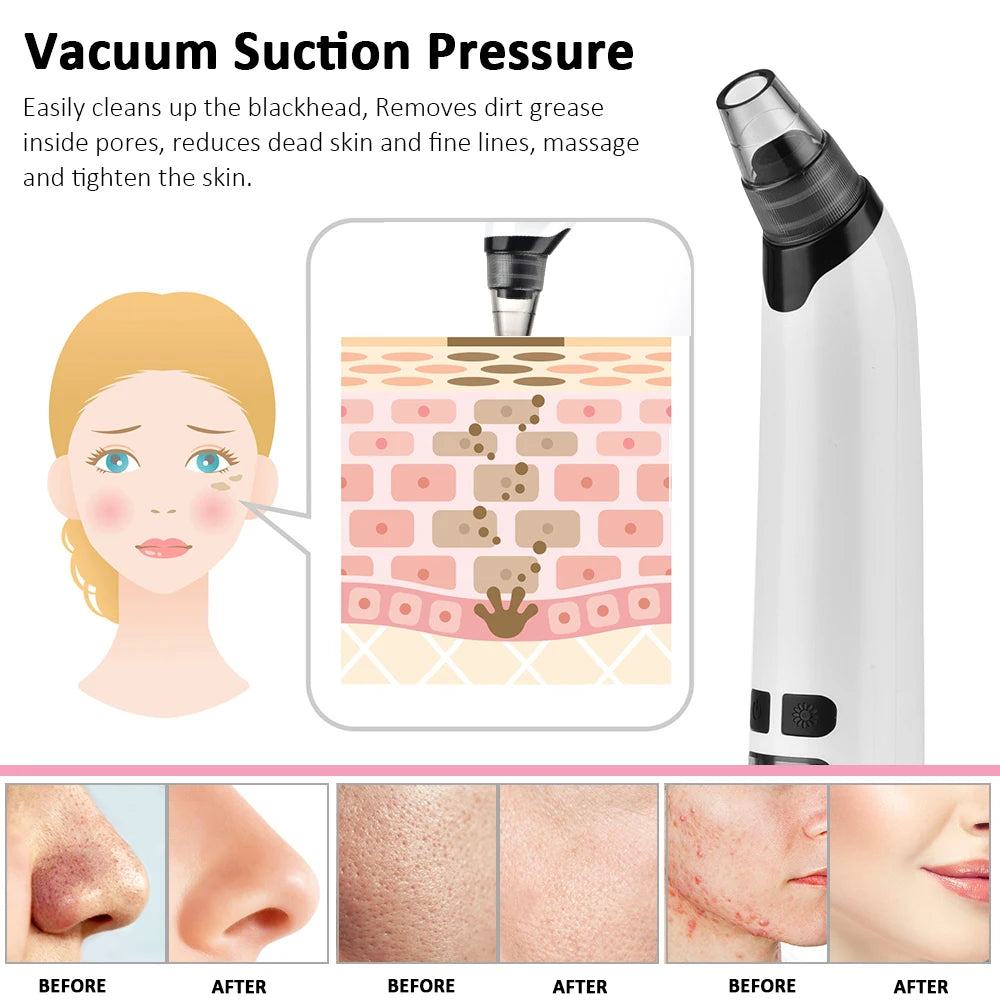Hailicare Electric Blackhead Remover Pore Vacuum Cleaner